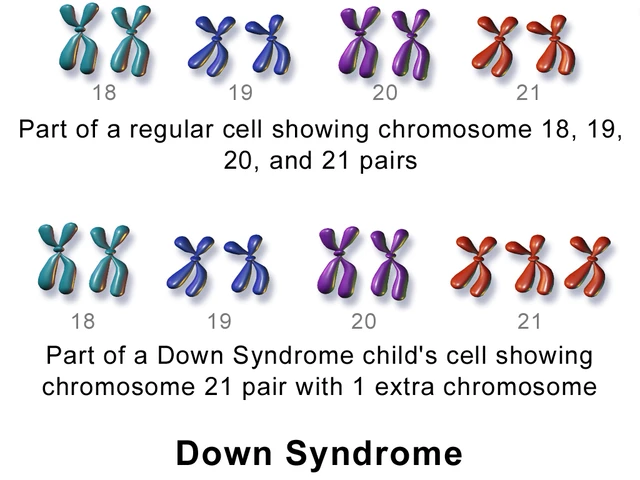 What causes Down syndrome?  NICHD - Eunice Kennedy Shriver National  Institute of Child Health and Human Development