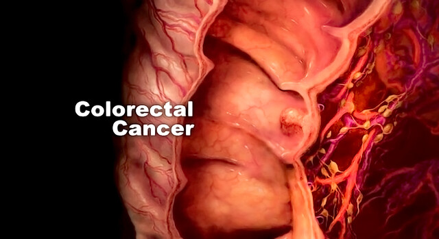 Colorectal Cancer Journey