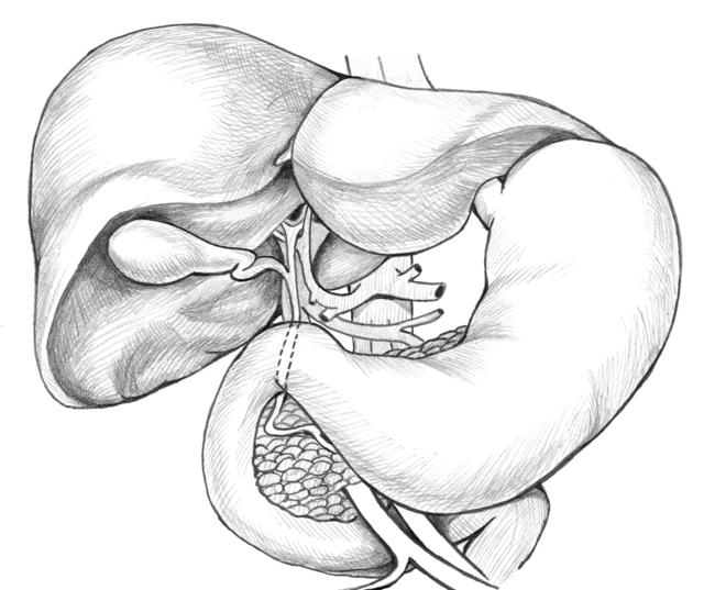Gallbladder Drawing