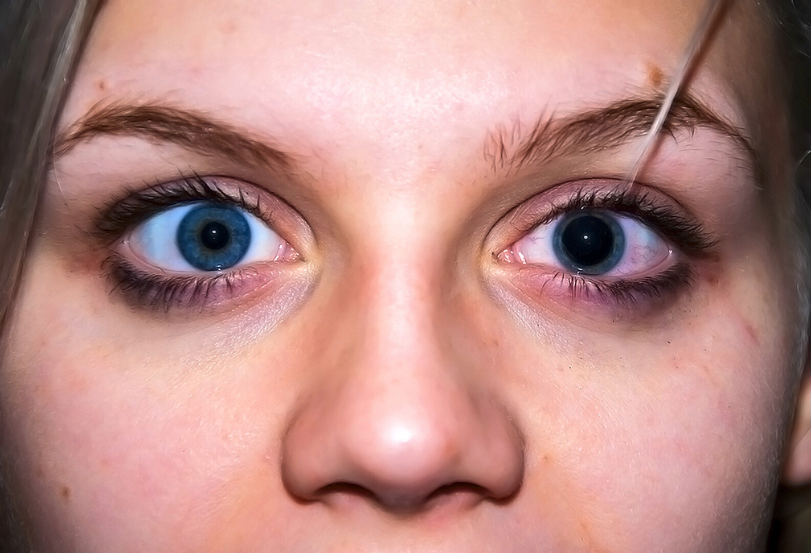 Вые глазах. Экзофтальм анизокория. Миоз мидриаз анизокория. Травматический мидриаз глаза.