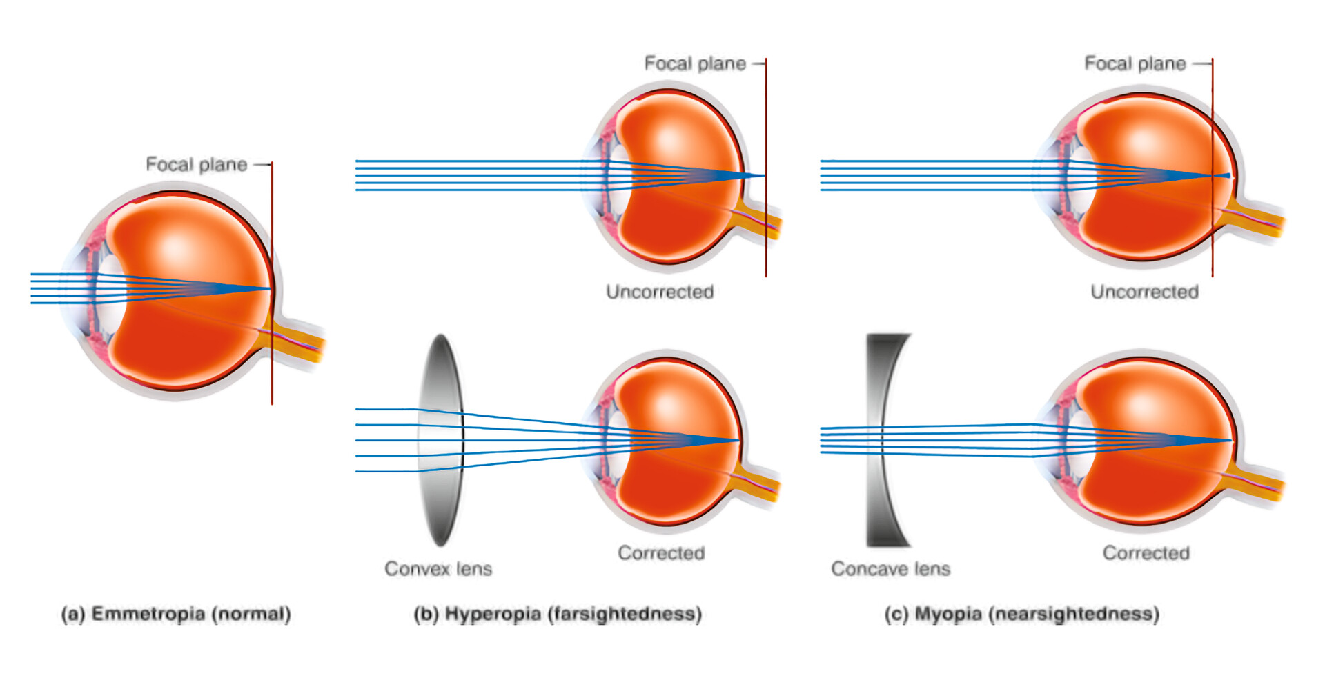 Common Eye Disorders Fast Facts Storymd