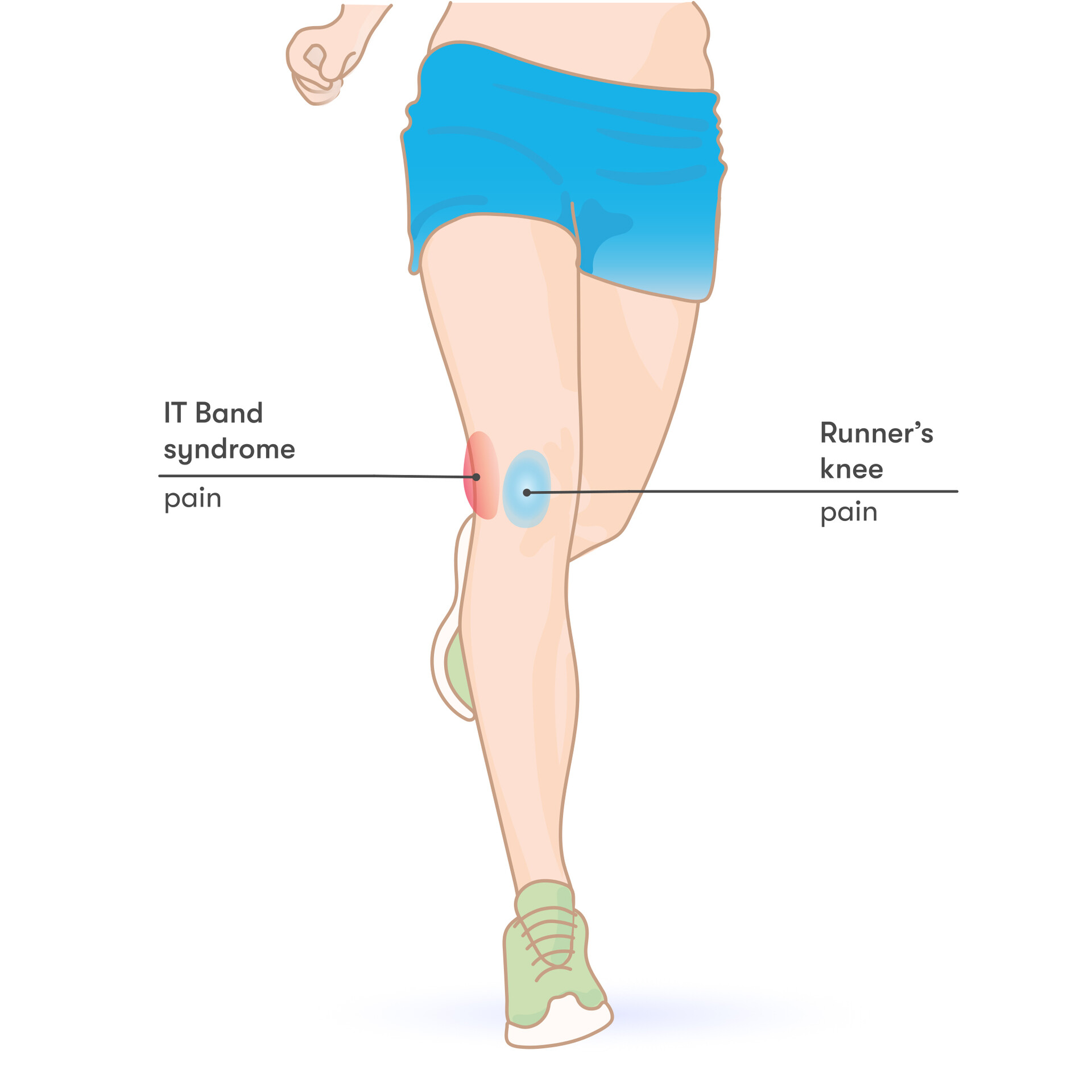 Iliotibial Band Syndrome (“Runner's Knee”)