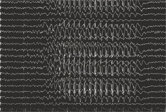 Myoclonic Absence Seizure Eeg
