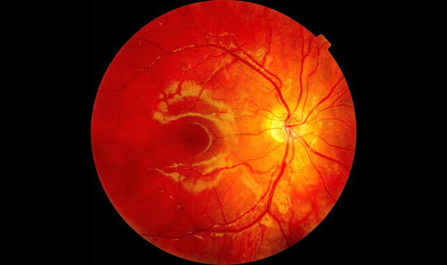 Macular Degeneration: Symptoms, Treatment, Prevention - StoryMD