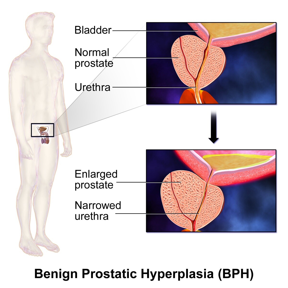 Lower urinary tract symptoms suggestive of benign prostatic hyperplasia may...