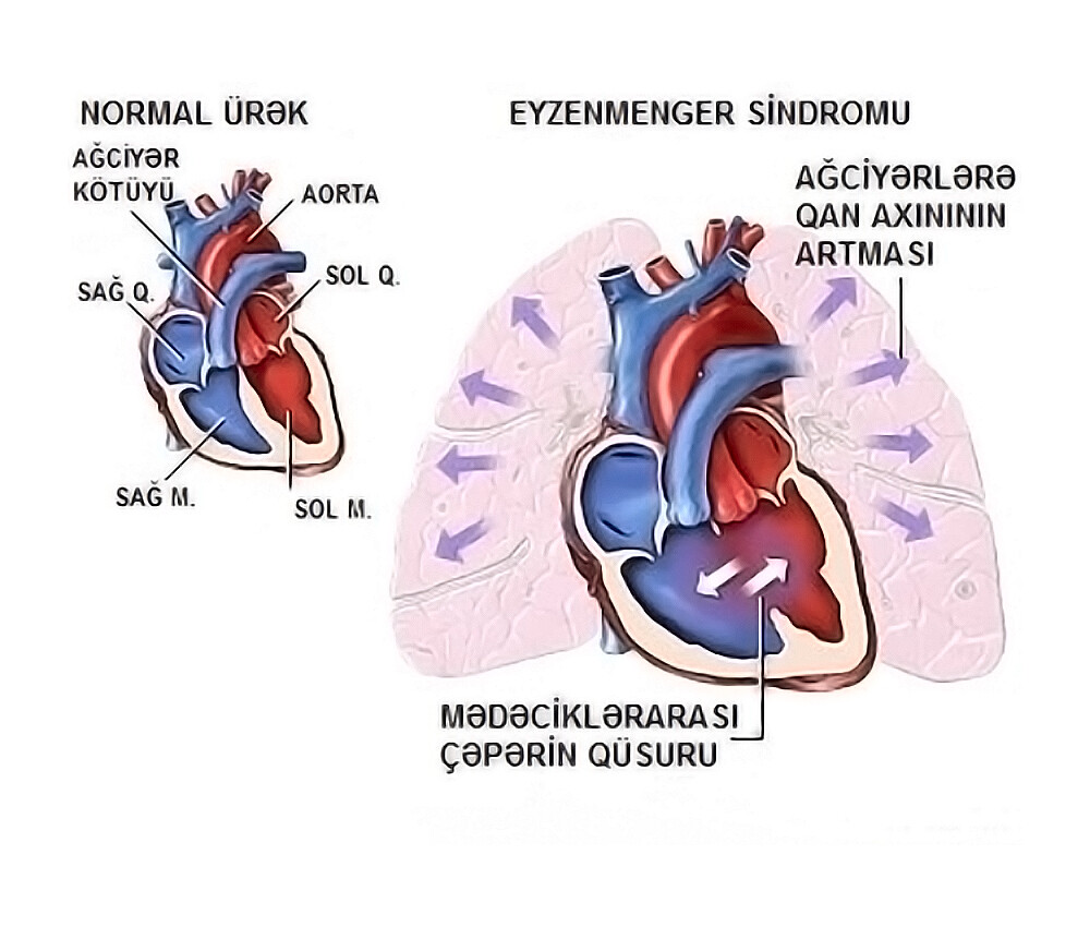 What Is Eisenmenger Syndrome? StoryMD