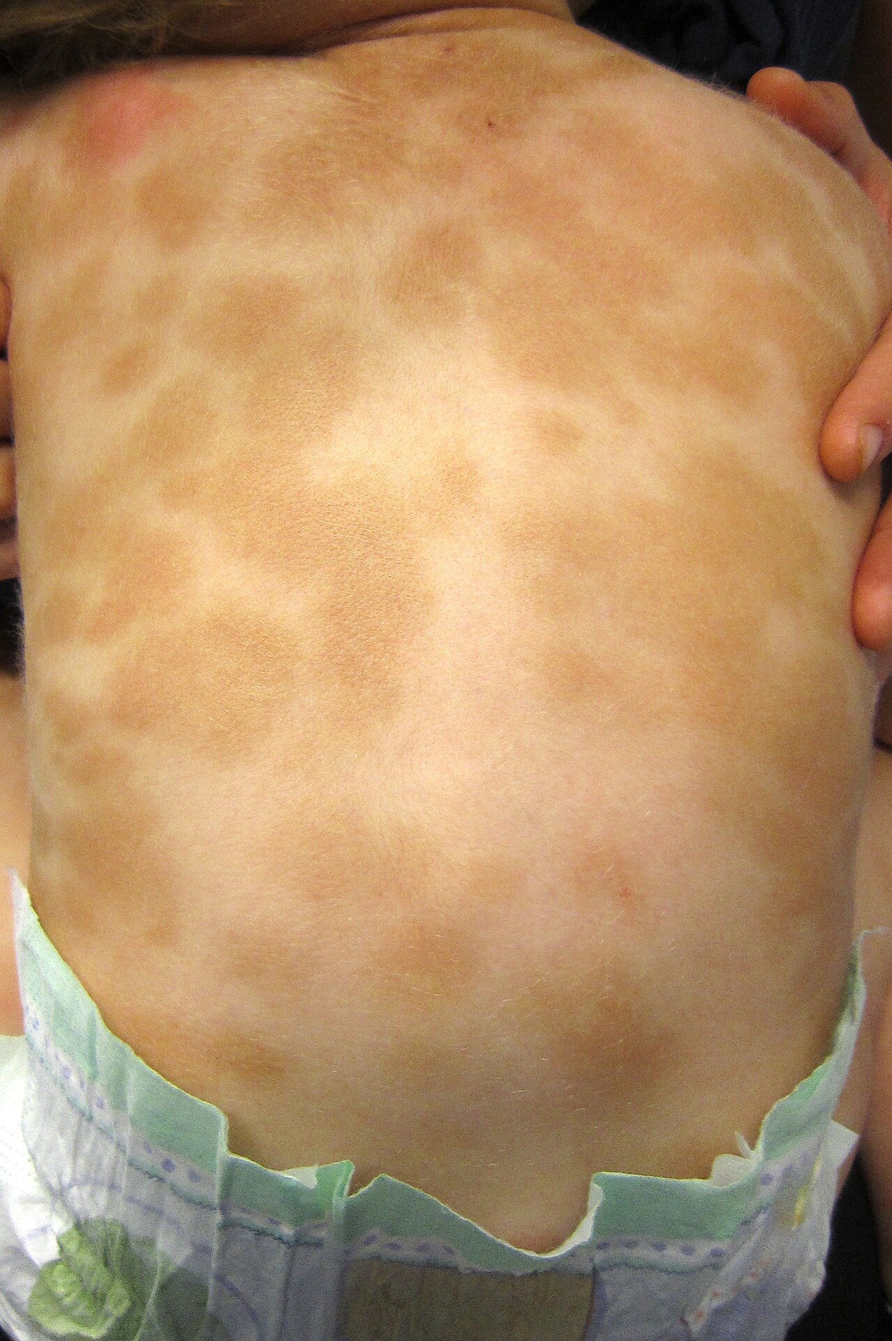 what-is-urticaria-pigmentosa-storymd