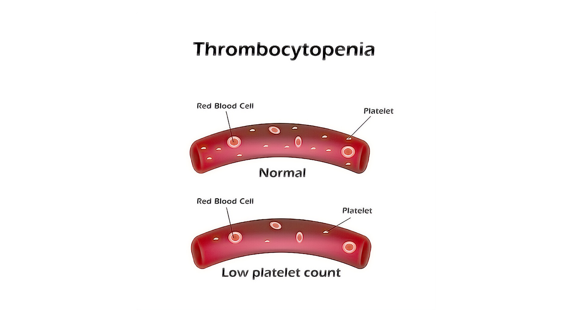 What Is Immune Thrombocytopenia? - StoryMD