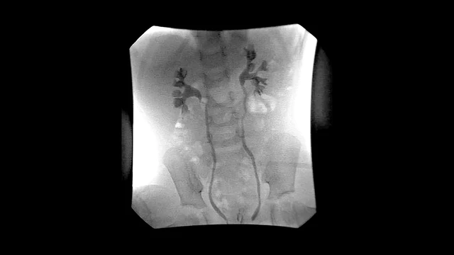 Hydronephrosis in Newborns - NIDDK