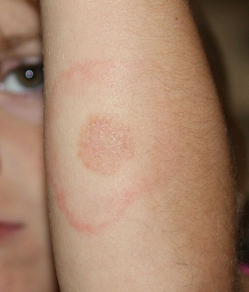 Chronic (Untreated) Lyme Disease - Lyme or Borreliosis-Symptoms-Diagnosis-treatment | Homeopathic | Best Homeopathic Doctor in Pakistan | Dr Qaisar Ahmed MD, DHMS