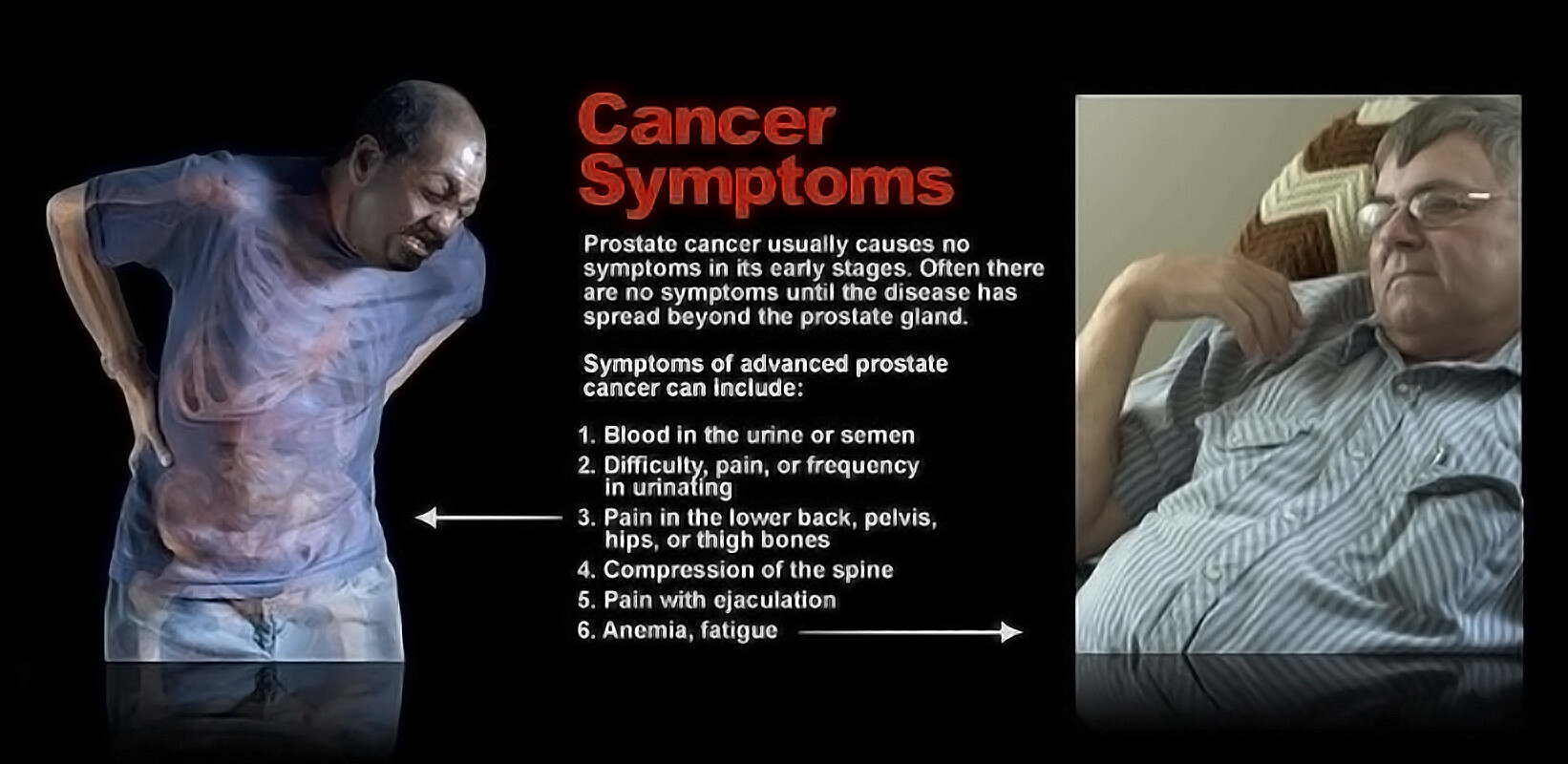 symptoms-of-advanced-prostate-cancer-storymd