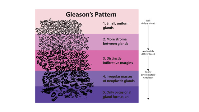 Prostate Adenocarcinoma Gleason
