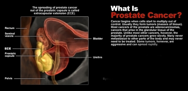Prostate Cancer - StoryMD