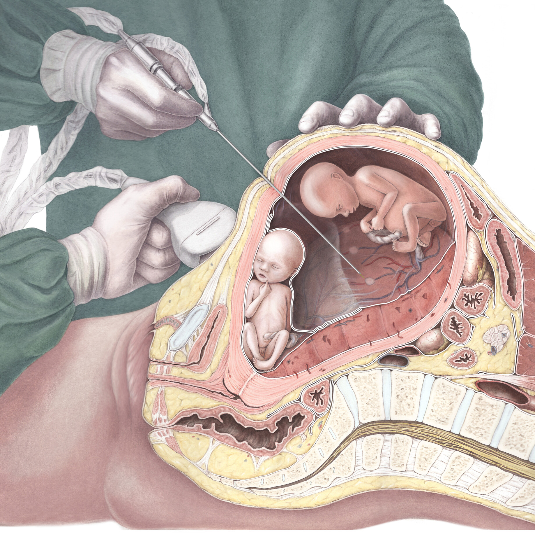 triplets fetus in womb