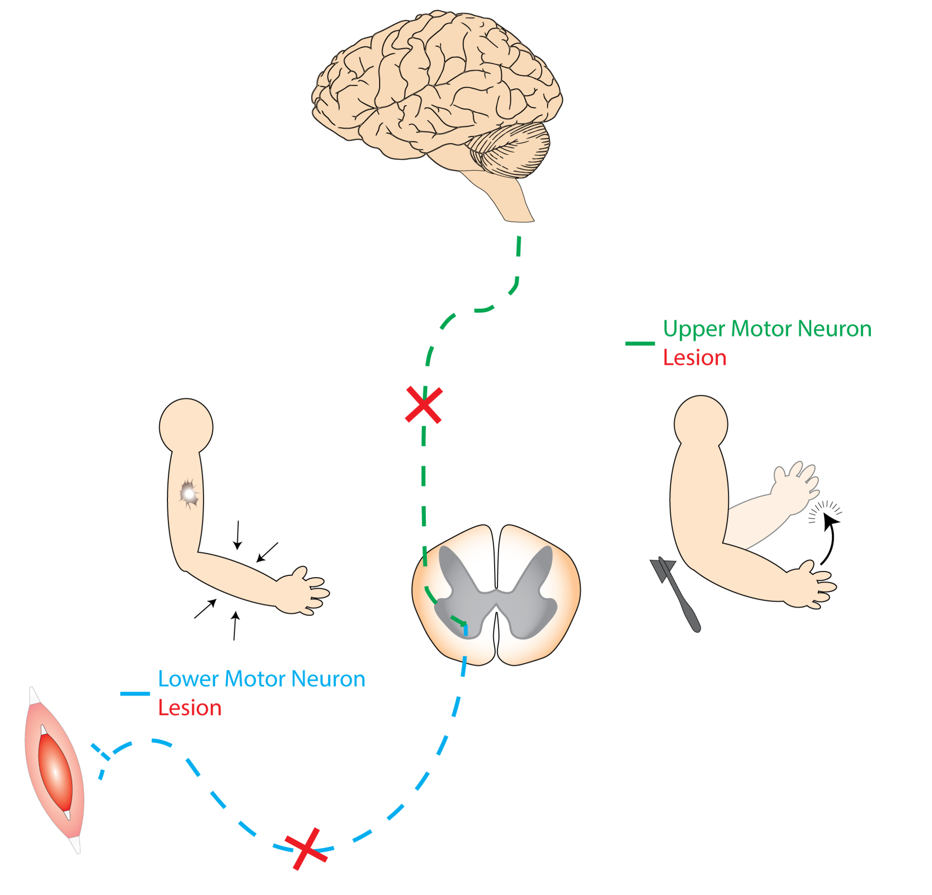 lower motor neuron location