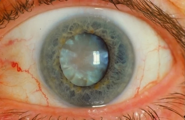 cerulean cataract