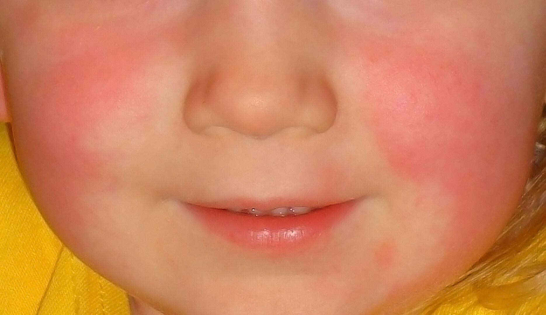 Strep A and Scarlet Fever Information - Munro Medical Centre