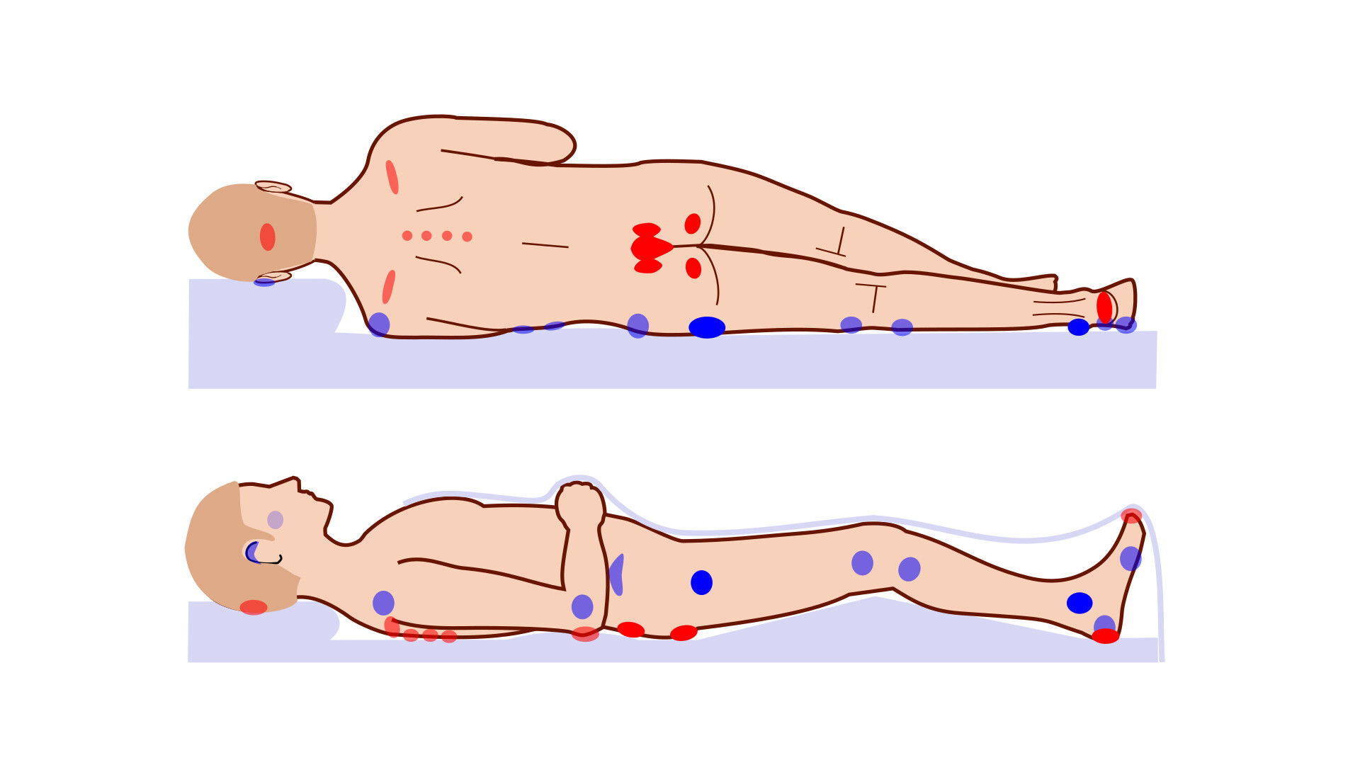 Pressure sores prone areas affected by body position on bed. (a).