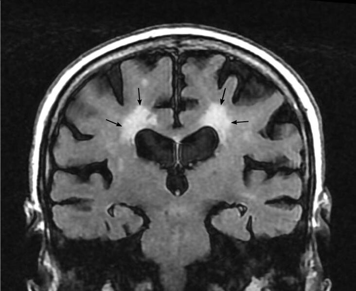 How Is Binswanger's Disease Diagnosed? StoryMD