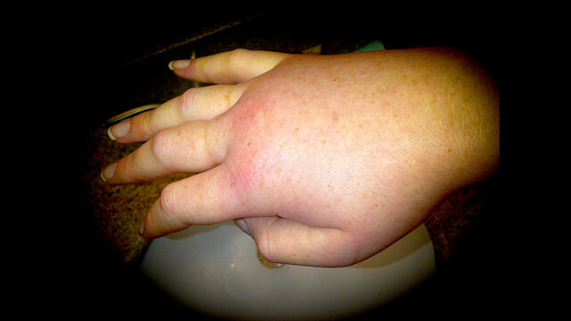 Hereditary Angioedema