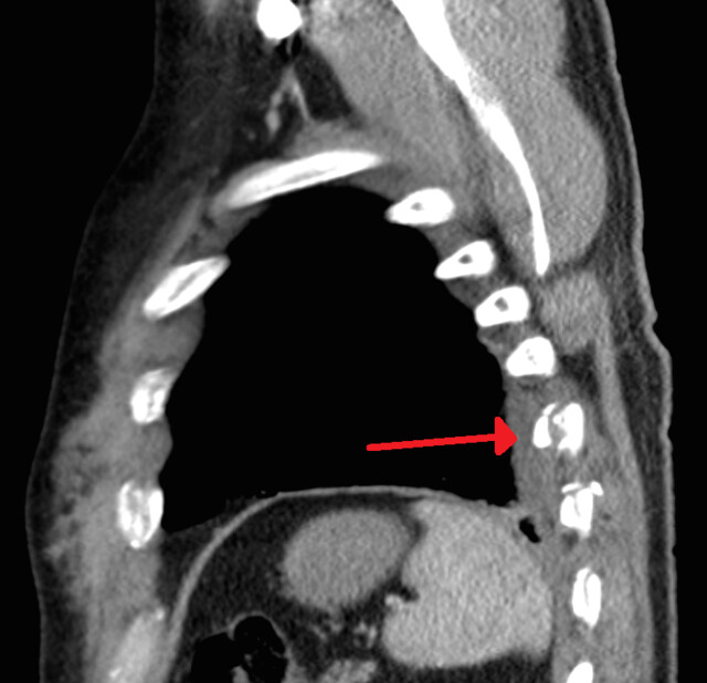 Rib Fractures - StoryMD