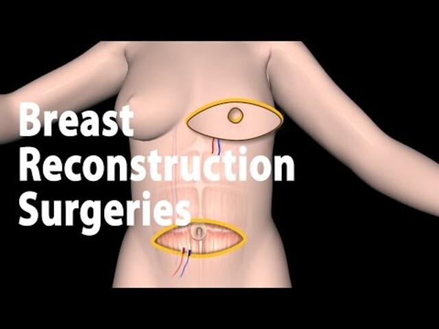 Exercises After Breast Surgery - StoryMD