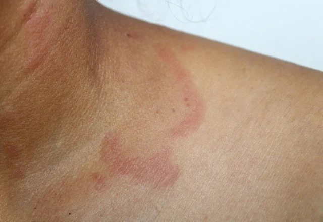 Lupus: An Attack From Within - StoryMD