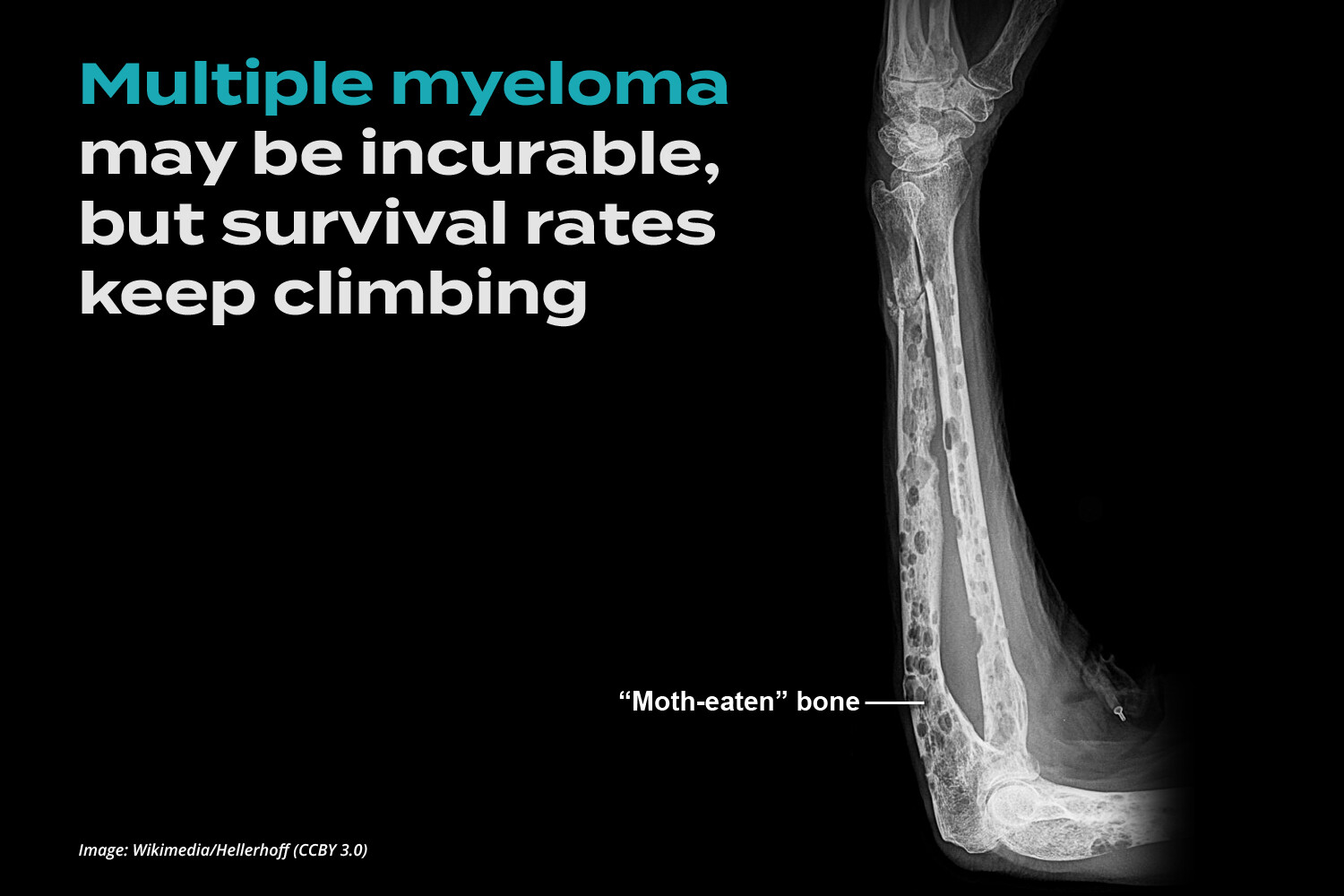 Multiple Myeloma X Ray Bone