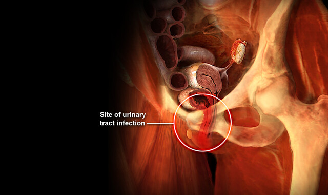 Cigarettes After Sex? Trying Peeing Instead to Prevent a UTI. - StoryMD