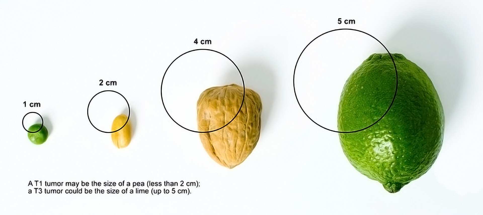 stages-of-testicular-cancer-storymd