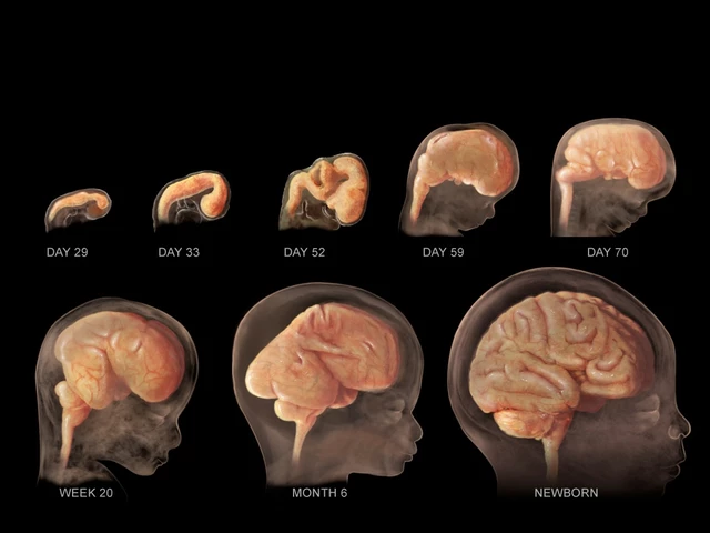 Megalencephaly Capillary Malformation
