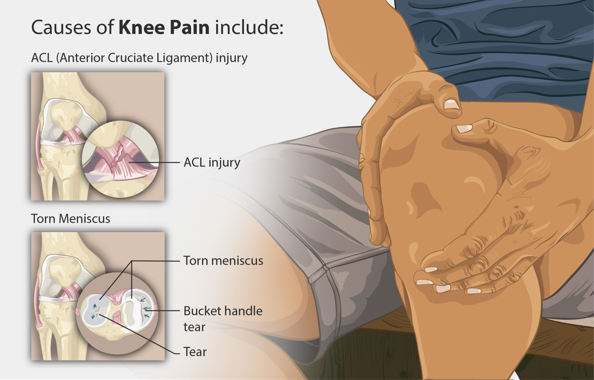 Anterior Cruciate Ligament Injury – ACL Injury - Knee Education, image size:1920x1228