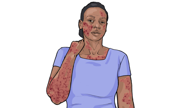 What Is Hartnup Disease? - StoryMD