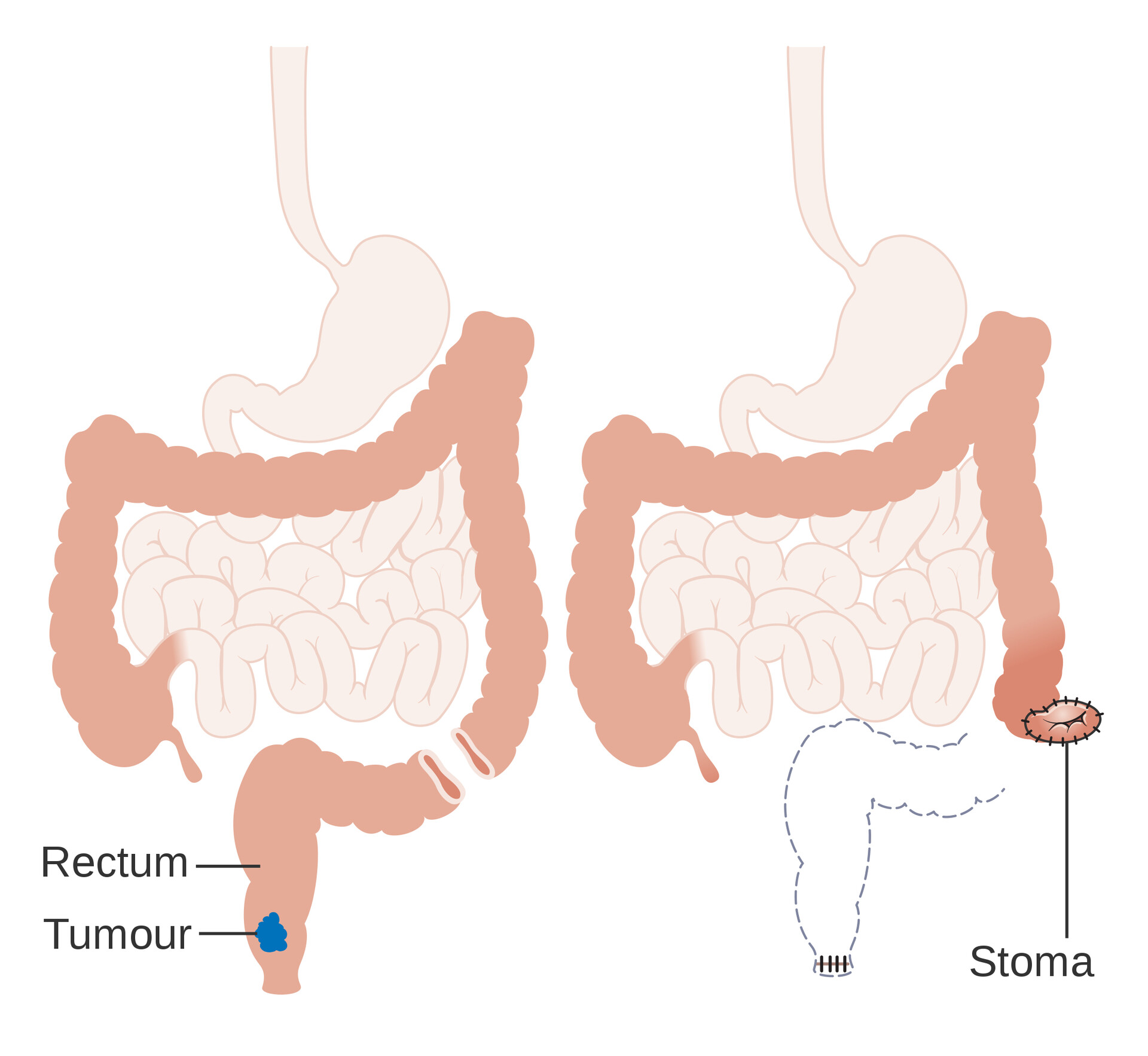 Ostomy Surgery of the Bowel - NIDDK