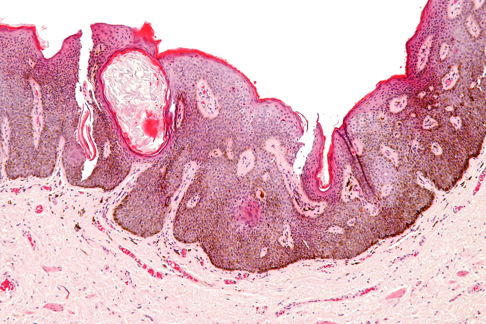 Punctate Palmoplantar Keratoderma Type I - StoryMD