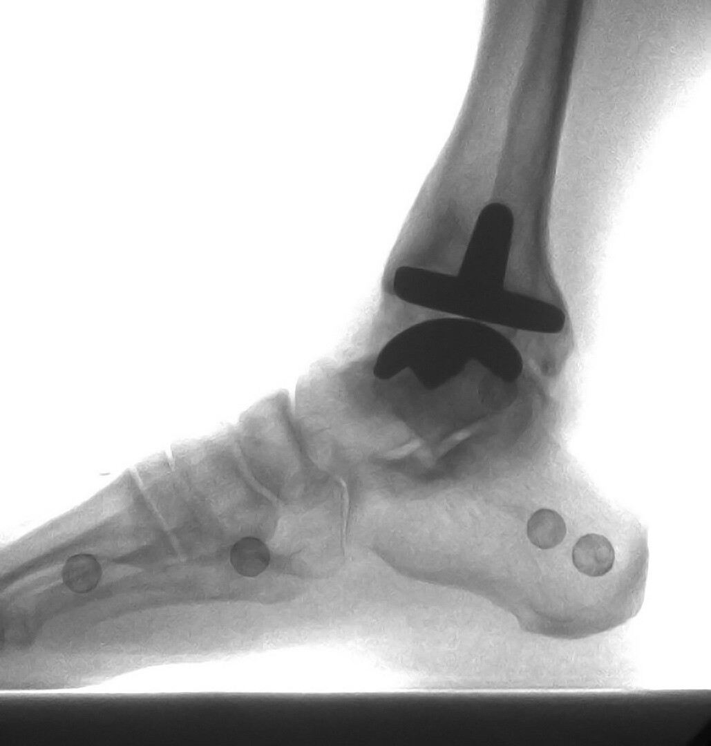 Arthroplasty, Replacement, Ankle StoryMD