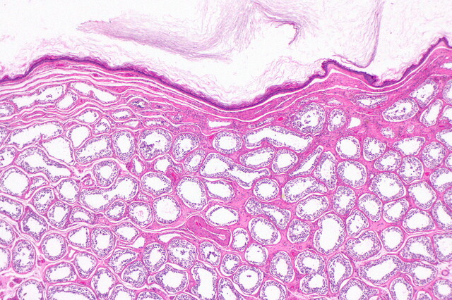 Saccular Cyst Histology