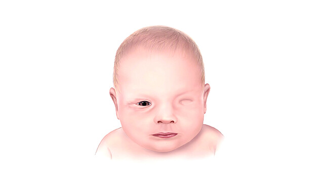 Ophthalmo-Acromelic Syndrome