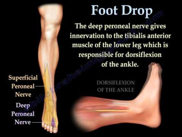 Foot Drop - StoryMD