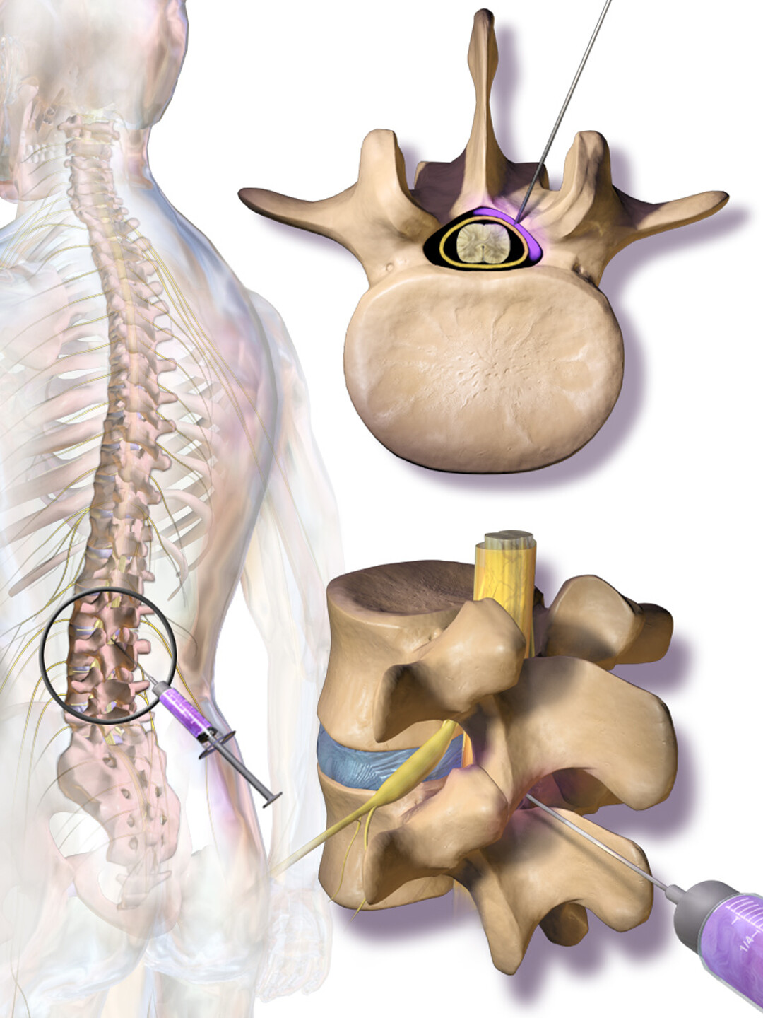 Sciatica - StoryMD