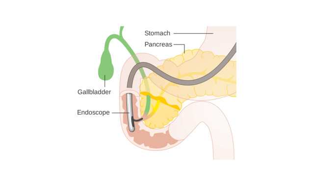 Endoscopic Retrograde Cholangiopancreatography Endoscopic Retrograde