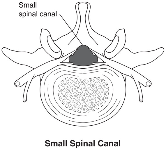 What Is Spinal Stenosis? - StoryMD