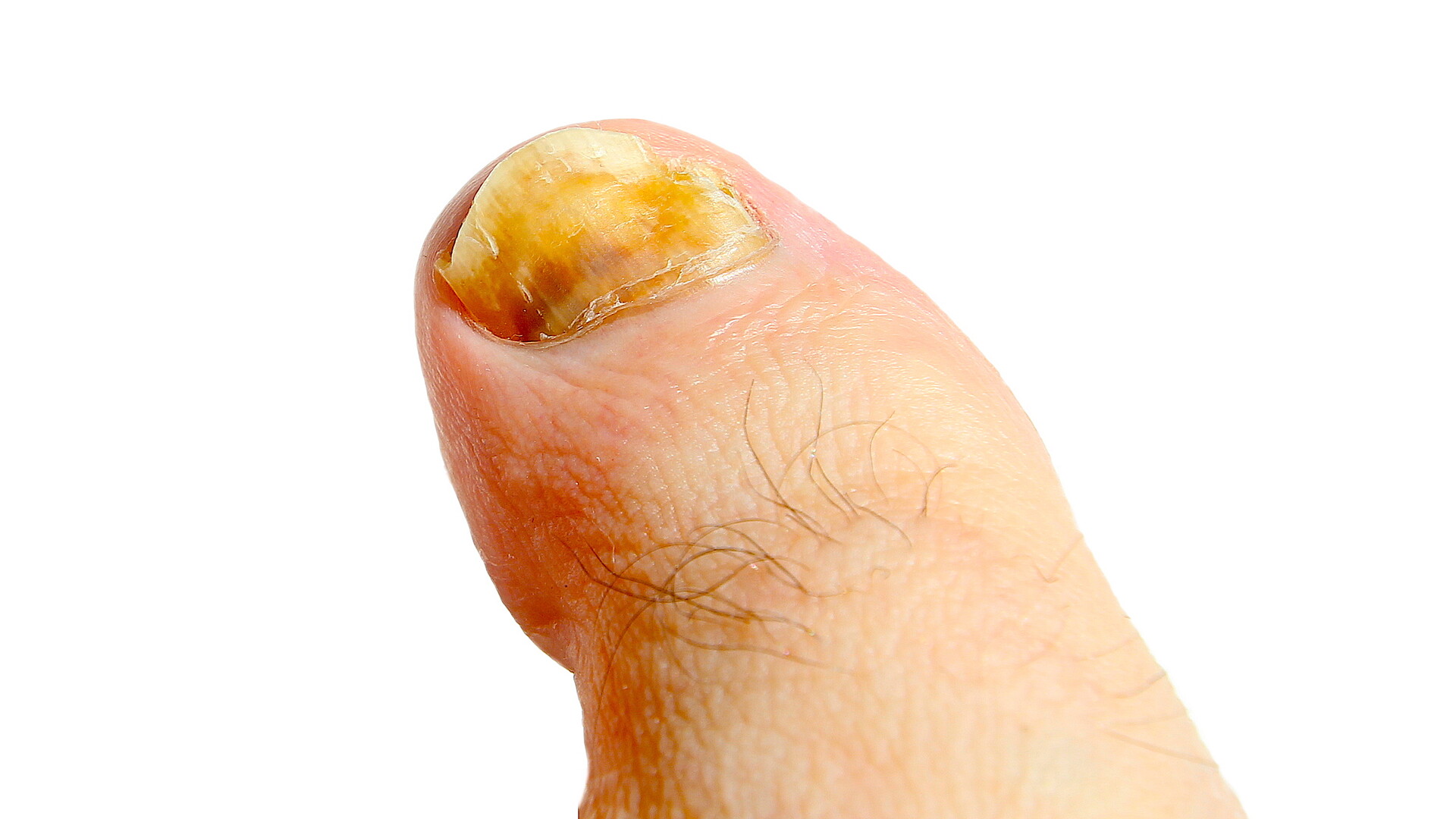 Womans Thumb Finger Of Foot Is A Wound And Bleeding On Cement Background  Close Up Shot Asian Body Skin Part Healthcare Concept Stock Photo -  Download Image Now - iStock