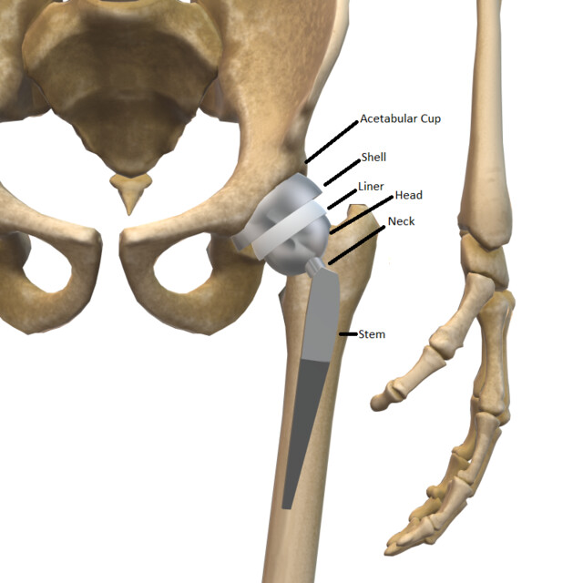Anatomy, Bony Pelvis and Lower Limb, Hip Joint - Clinical - StoryMD