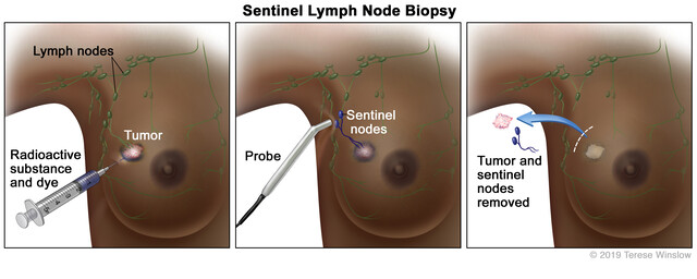 Sentinel Lymph Node Biopsy SLNB StoryMD