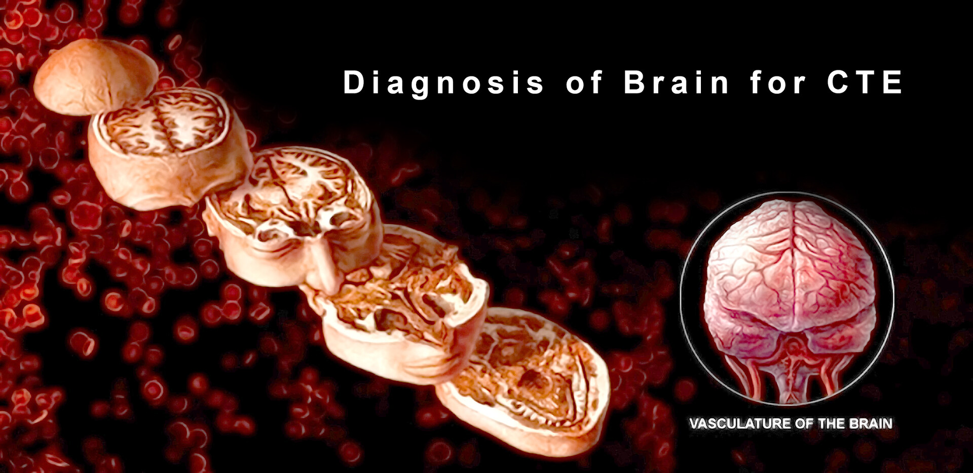 How Is CTE Diagnosed? StoryMD