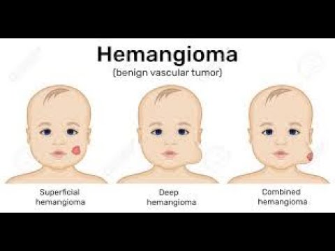 superficial hemangioma