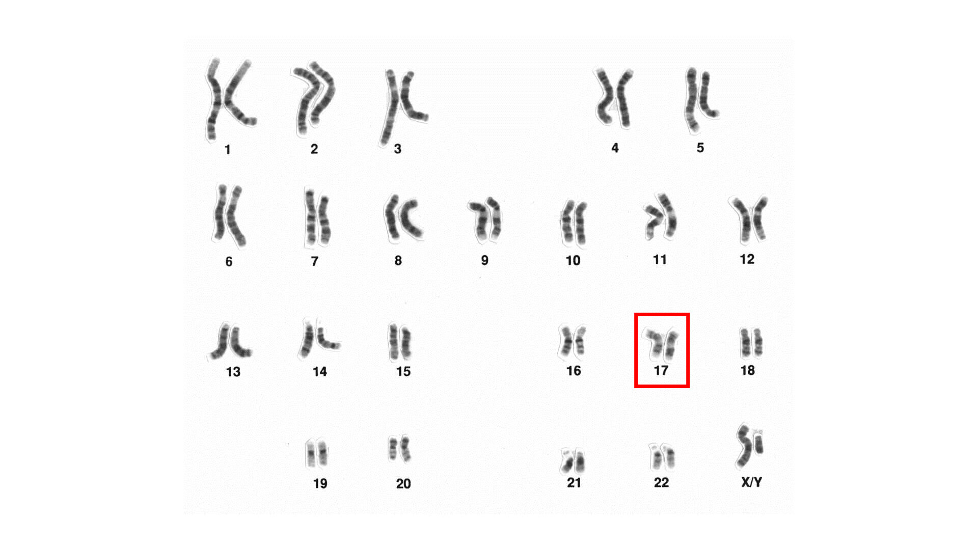 The patient's karyogram demonstrates a ring chromosome 18. | Download  Scientific Diagram