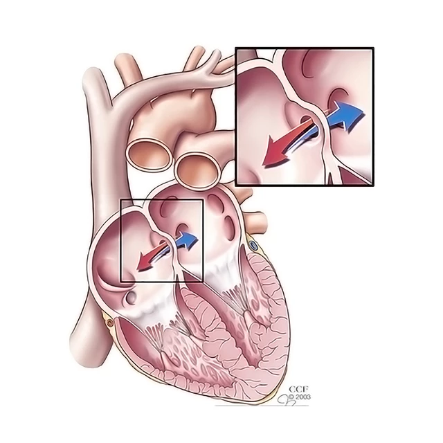 What Is Atrial Septal Defect? - StoryMD