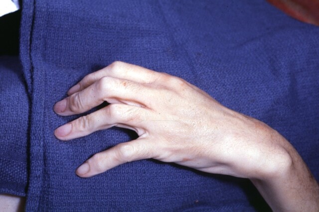 Arachnodactyly: fingers abnormally thin, long, and slender. The fingers